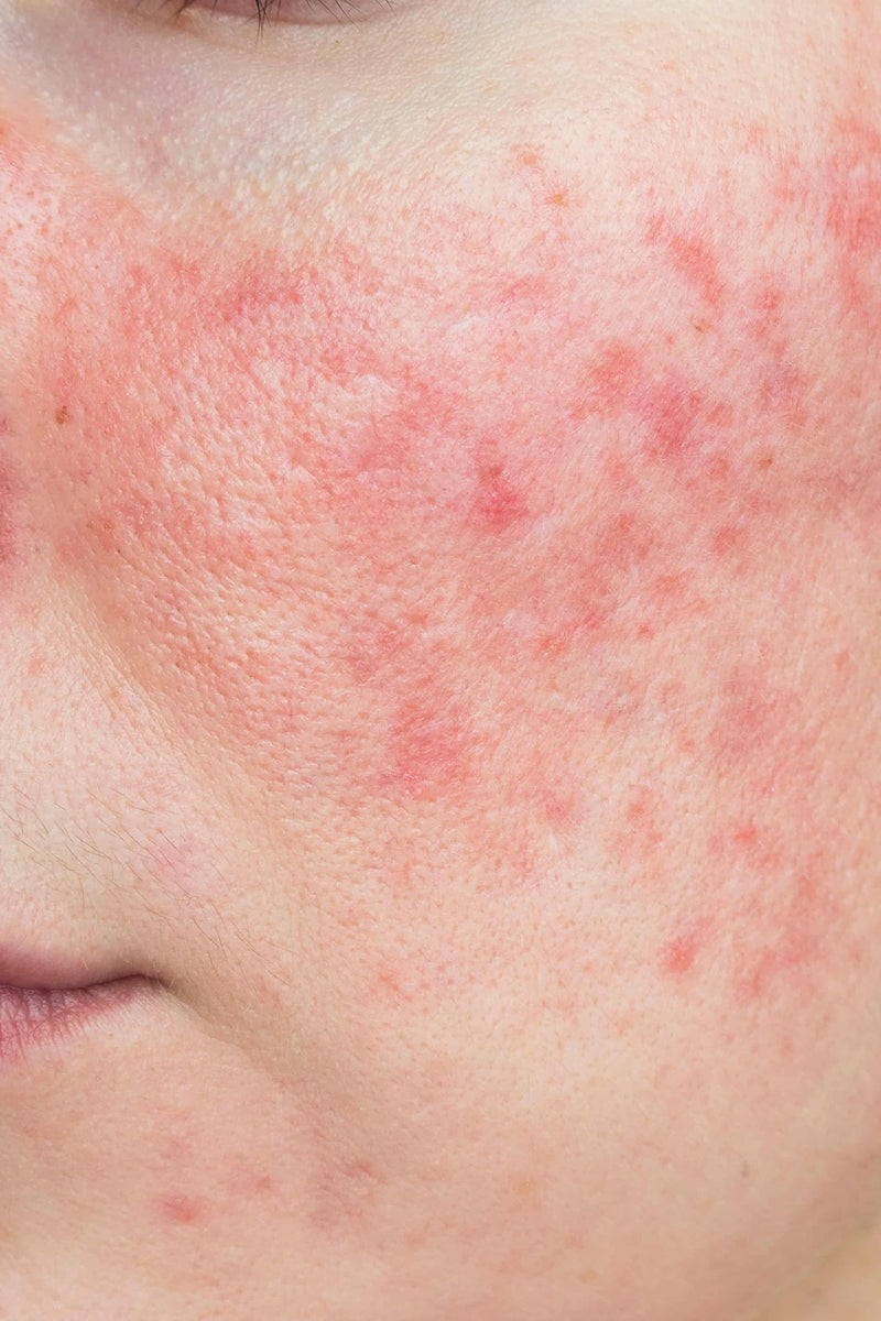 What’s your problem: Rosacea