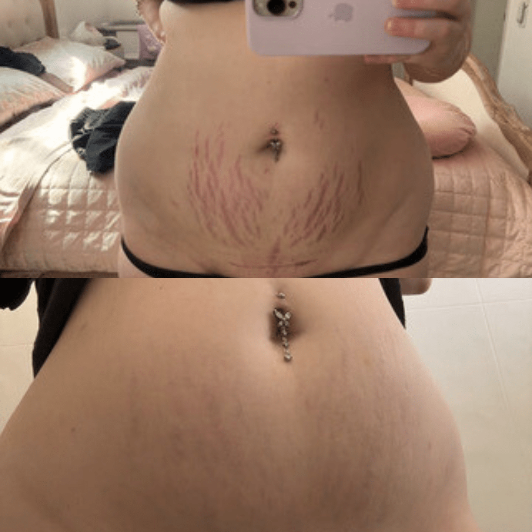 Stretch marks before and after using Glory Oil on stomach skin